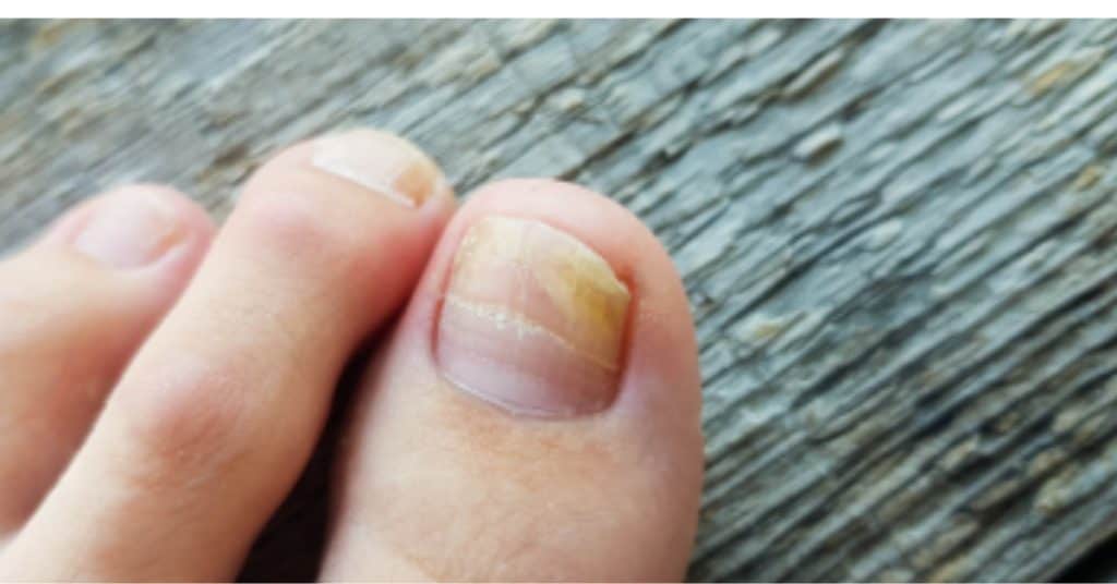 Kalknagel Behandelen? Ontdek Topproducten zoals Nailner en Mycosan