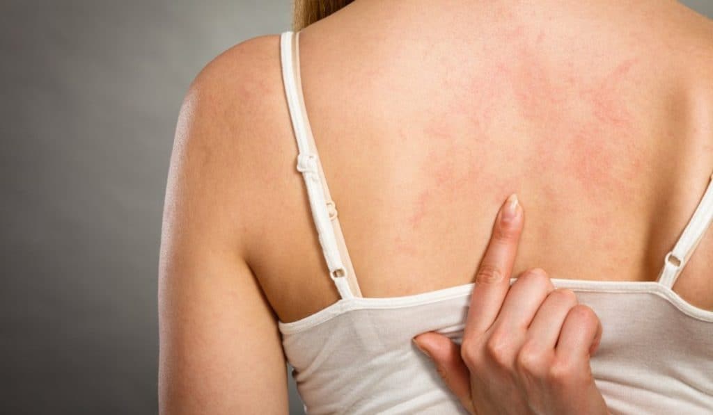 Alles over Zonneallergie
