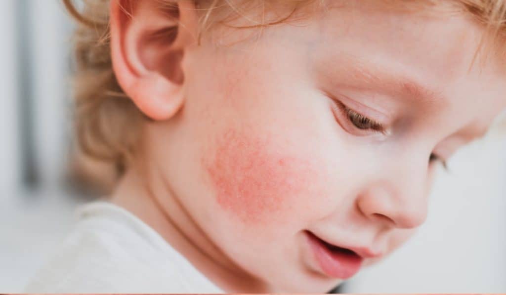 Warmtebultjes en Zonneallergie: Oorzaken, Symptomen en Behandeling