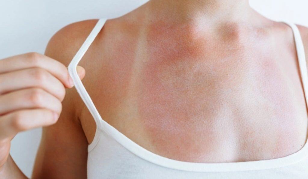 Zonneallergie